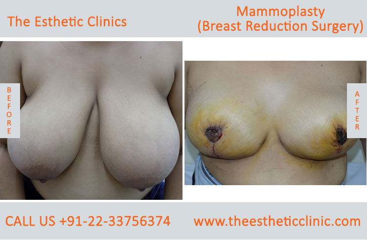 Mammoplasty, Breast Reduction Surgery before after photos in mumbai india (7)